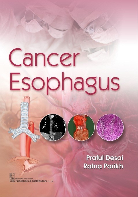 Cancer esophagus