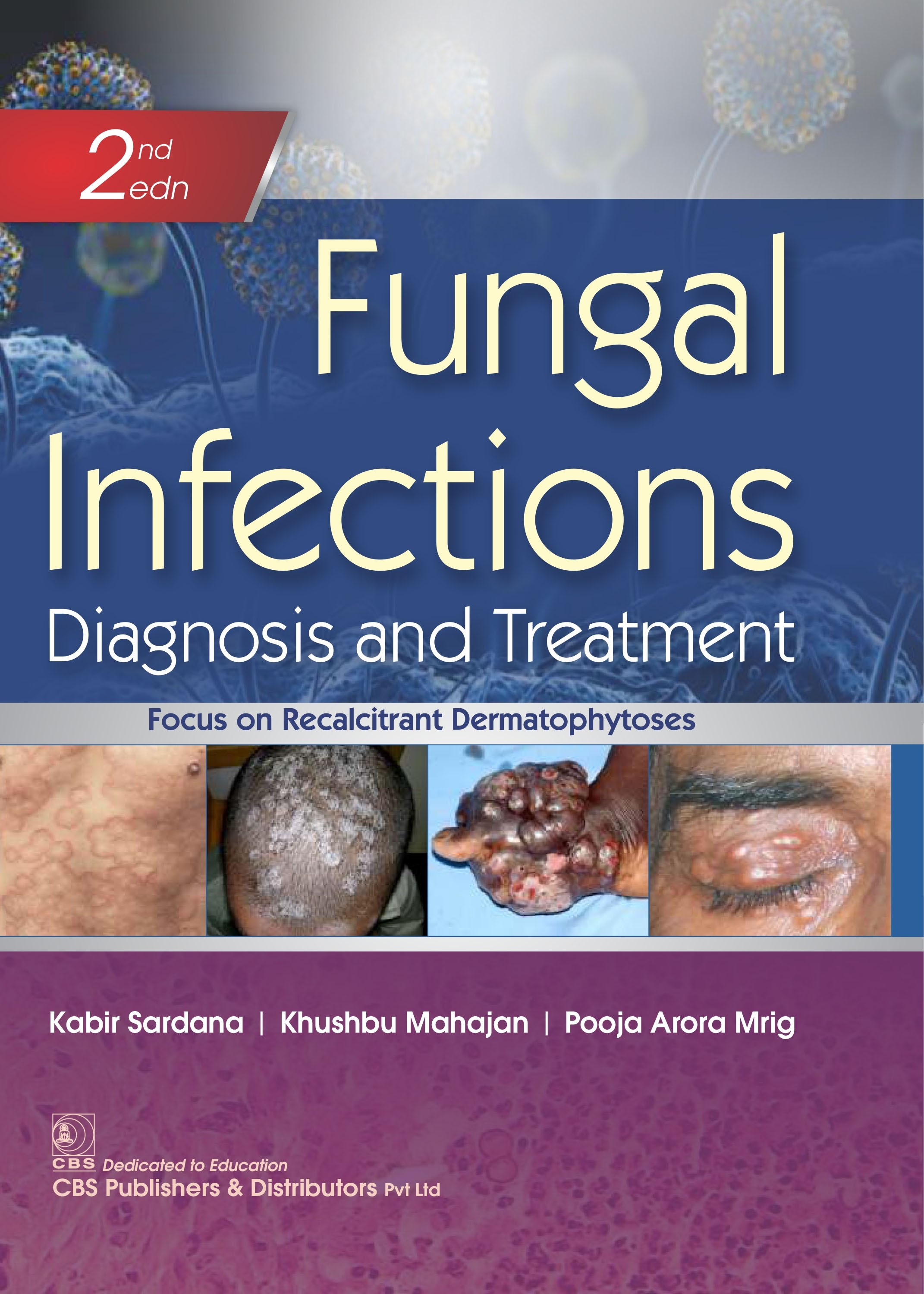 Fungal infections diagnosis and treatment