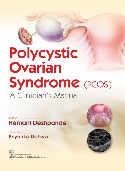 Polycystic ovarian syndrome (pcos): a clinician’s manual