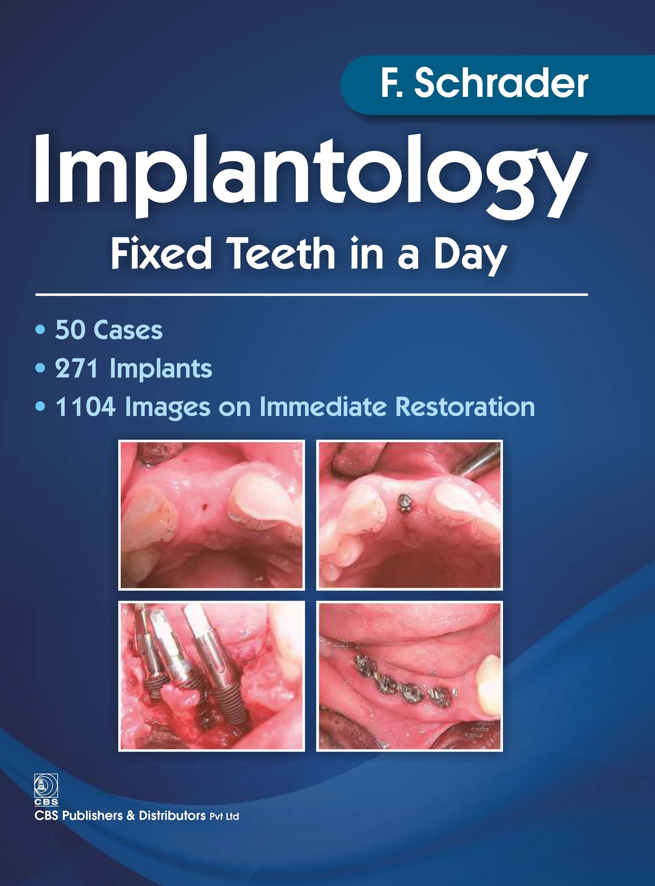 Implantology fixed teeth in a day