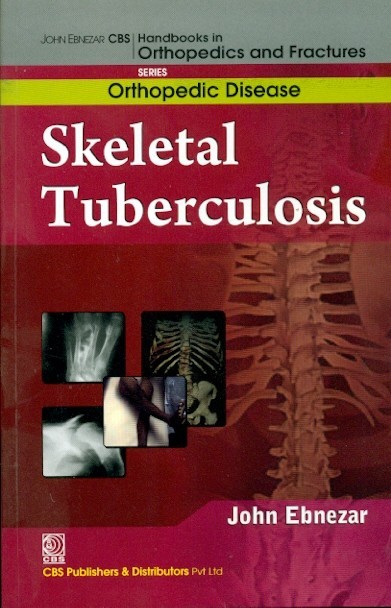 Skeletal tuberculosis (handbooks in orthopedics and fractures series, vol.33: orthopedic diseases)