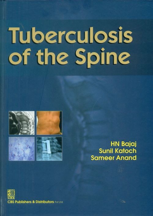 Tuberculosis of the spine