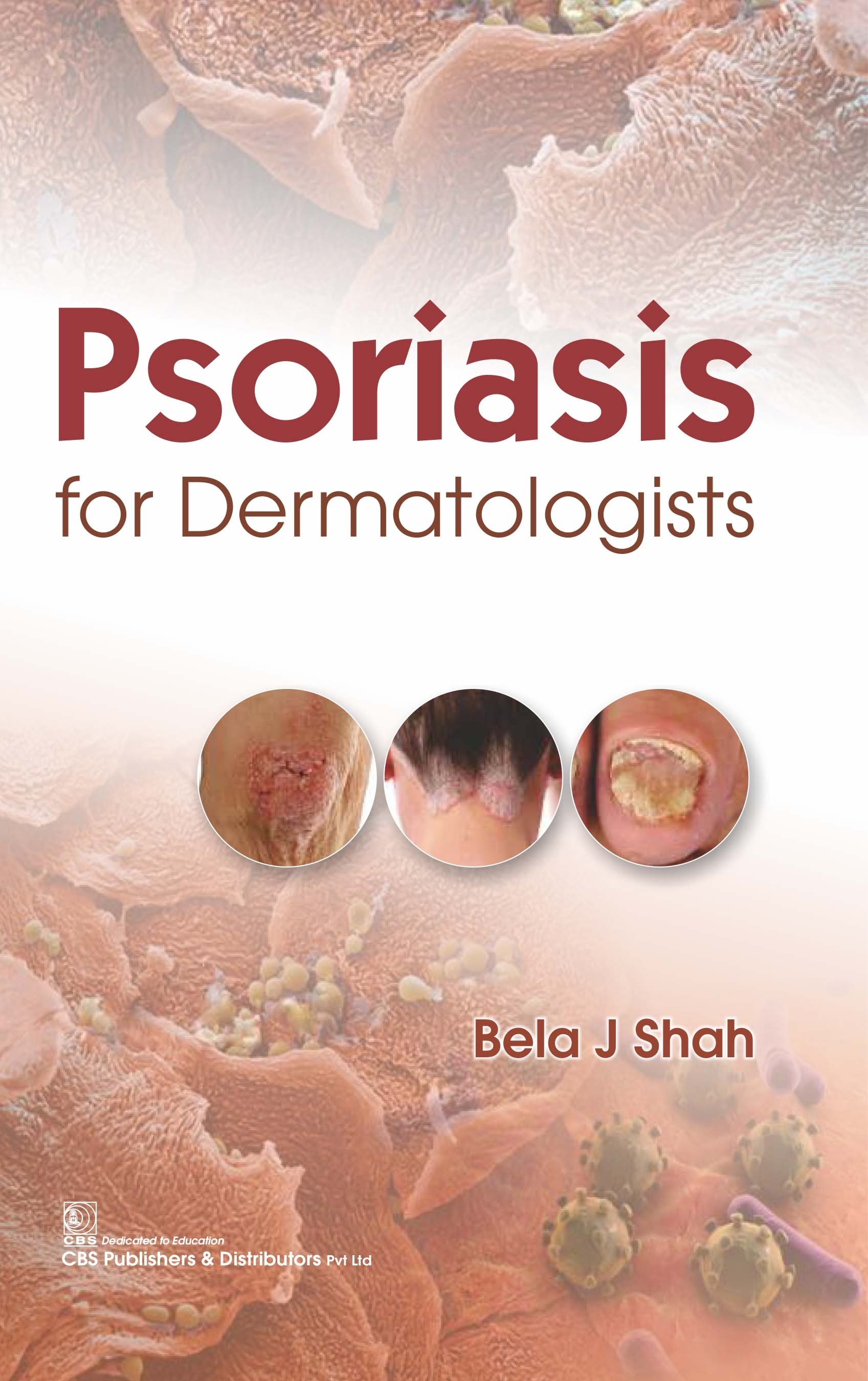 Psoriasis for dermatologists