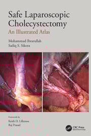 Safe laparoscopic cholecystectomy an illustrated atlas (pb 2022)